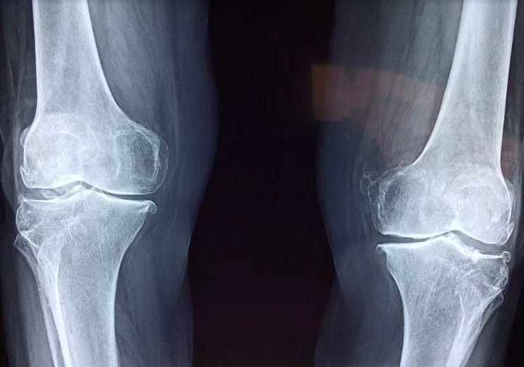 síntomas de la osteoporosis