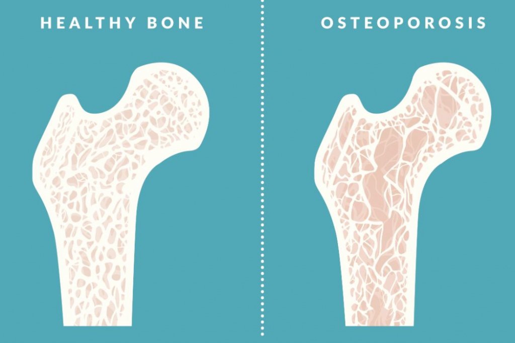 que es la osteoporosis que es la osteoporosis